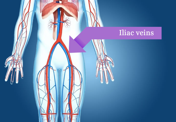 Vascular interventions, for whom and when: